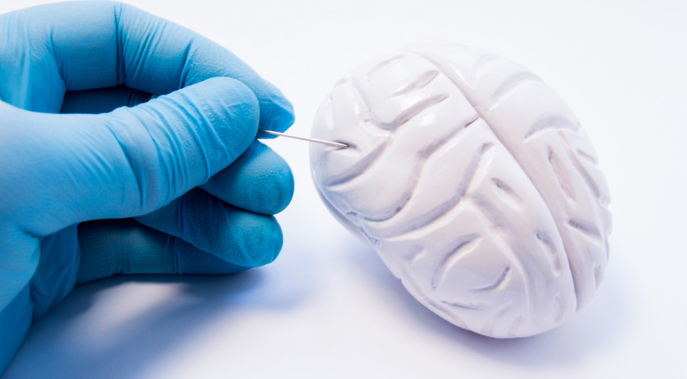 imagen Presentan nuevo modelo informático de neurocirugía estereotáctica para toma de muestras de tumores cerebrales 